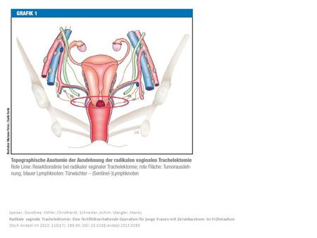 Speiser, Dorothee; Köhler, Christhardt; Schneider, Achim; Mangler, Mandy Radikale vaginale Trachelektomie: Eine fertilitätserhaltende Operation für junge.