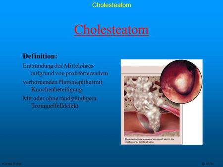 Cholesteatom Definition: