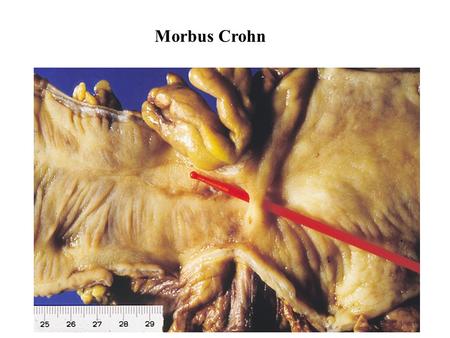 Morbus Crohn.