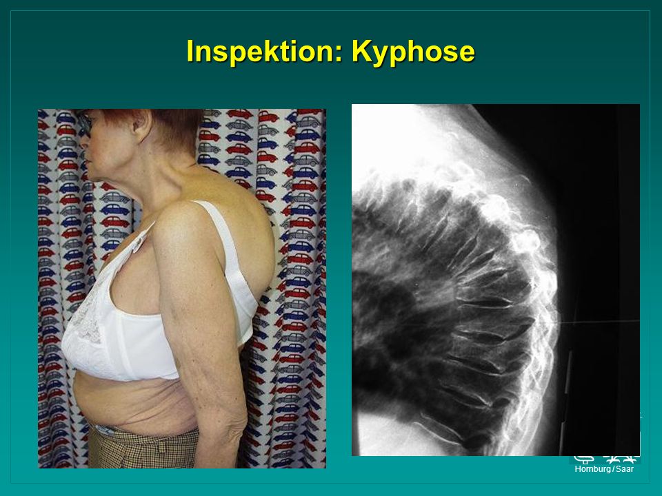 Inspektion: Kyphose Orthop. Univ. Klinik. Homburg / Saar