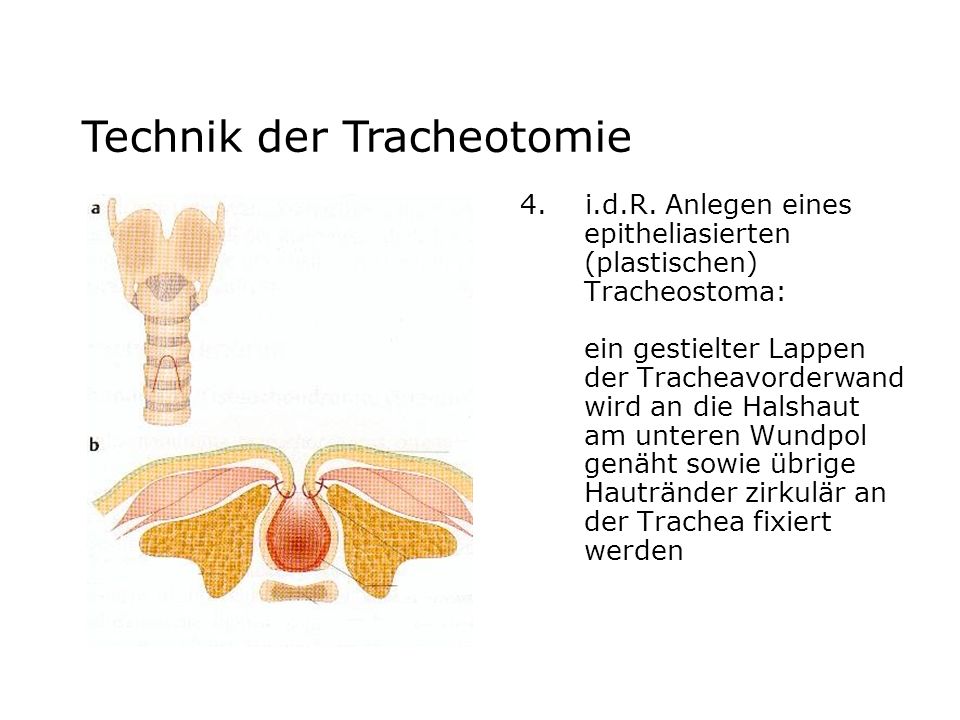 Technik der Tracheotomie