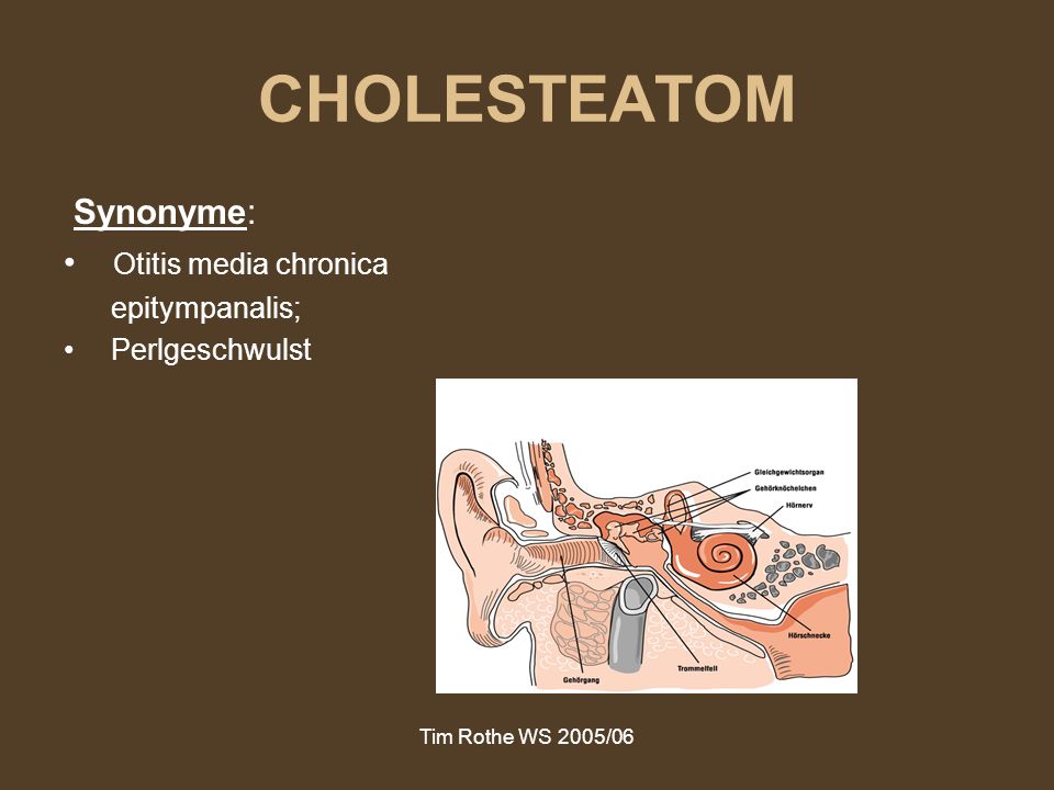 CHOLESTEATOM Synonyme: Otitis media chronica epitympanalis;