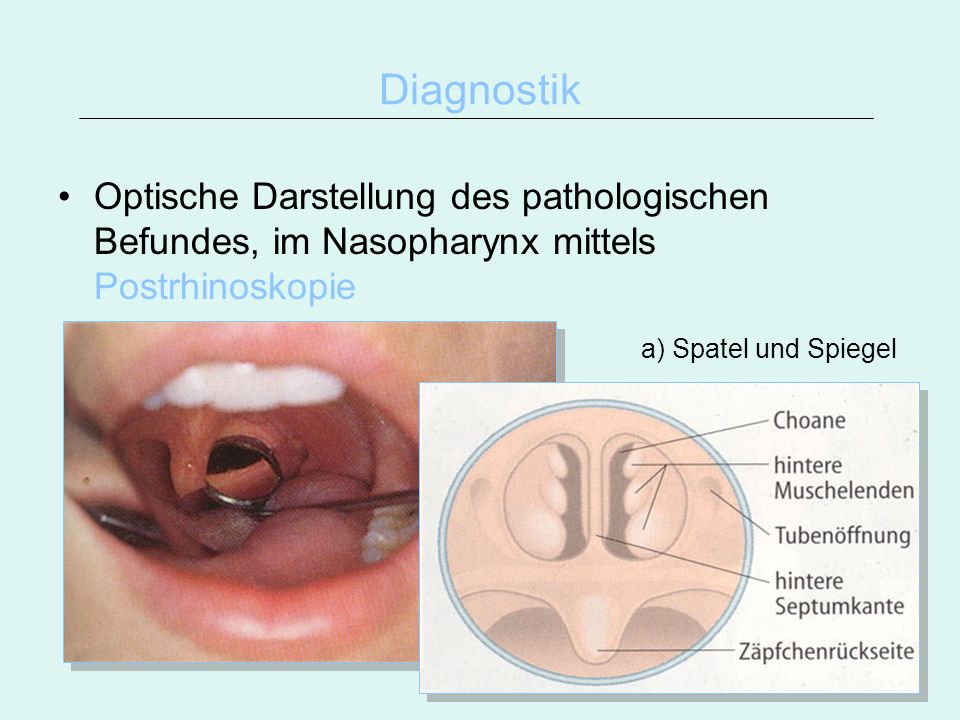 Diagnostik Optische Darstellung des pathologischen Befundes, im Nasopharynx mittels Postrhinoskopie.