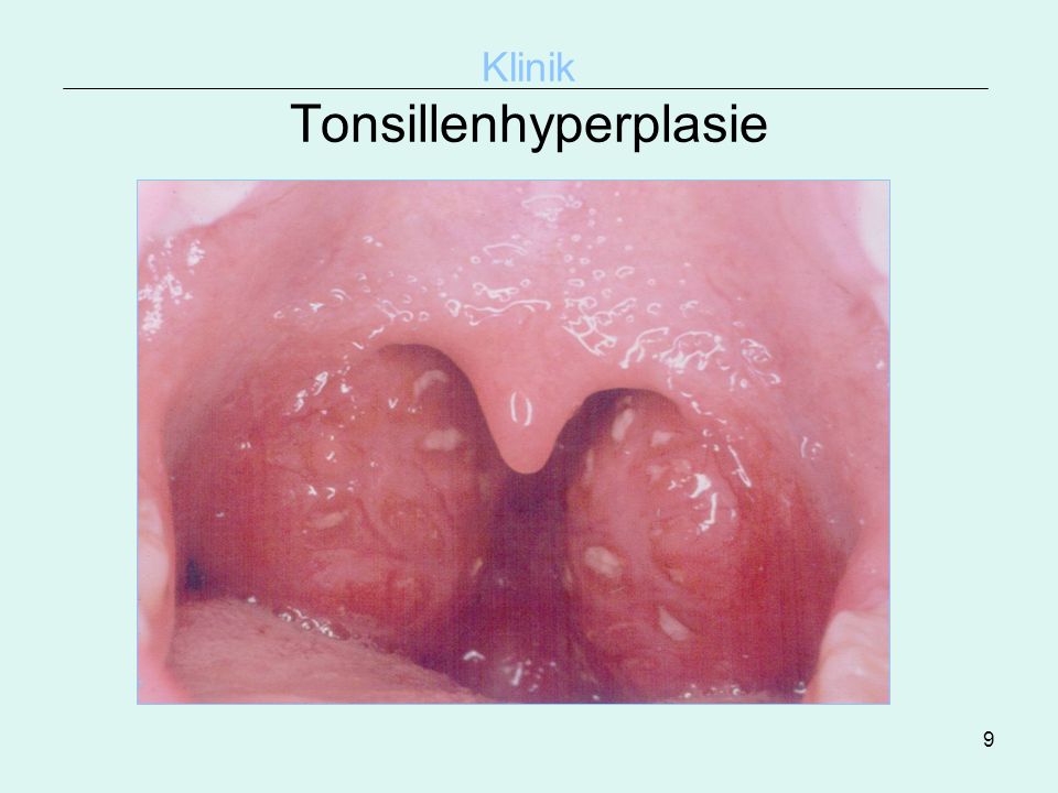 Klinik Tonsillenhyperplasie