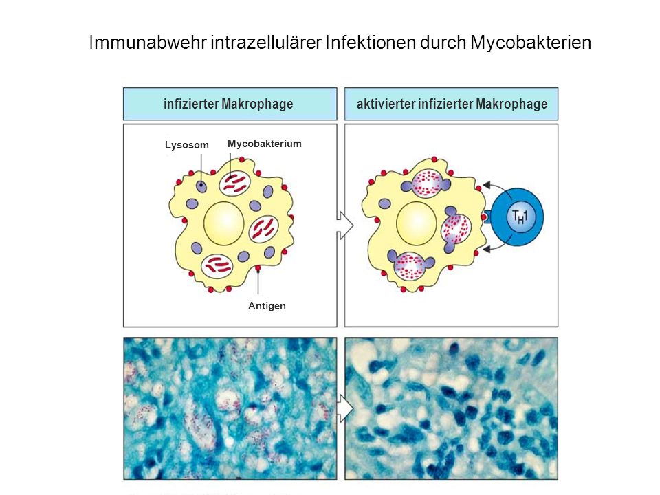Immunabwehr intrazellulärer Infektionen durch Mycobakterien