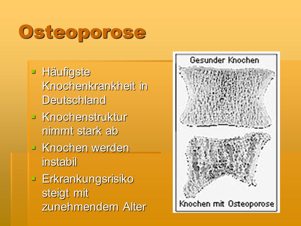 Osteoporose Häufigste Knochenkrankheit in Deutschland