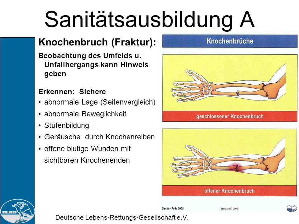 Sanitätsausbildung A Knochenbruch (Fraktur):