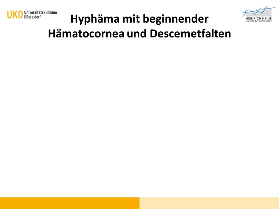 Hyphäma mit beginnender Hämatocornea und Descemetfalten