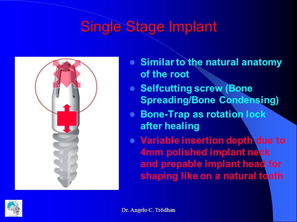 Single Stage Implant Similar to the natural anatomy of the root
