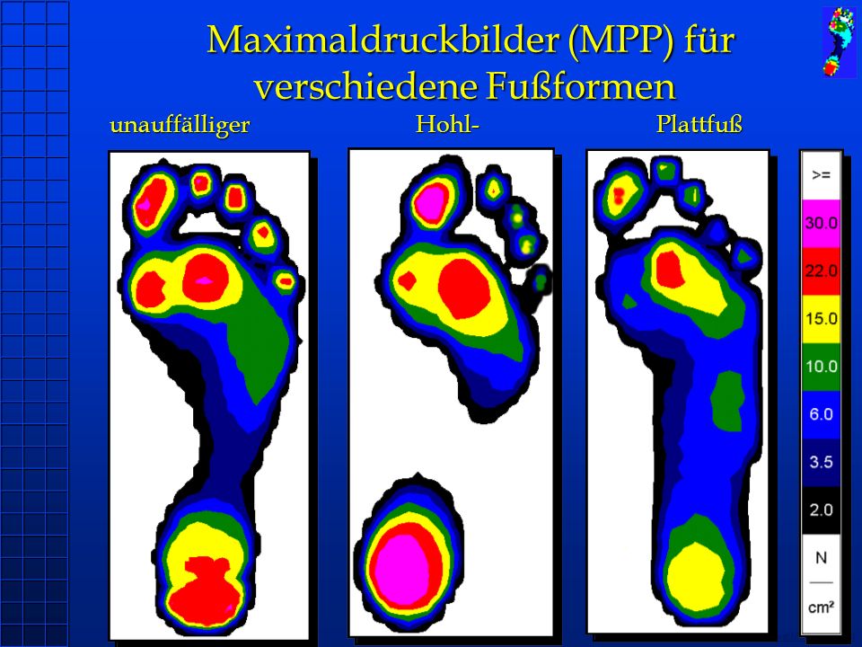 Maximaldruckbilder (MPP) für verschiedene Fußformen unauffälliger