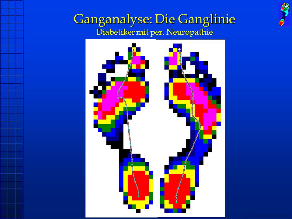 Ganganalyse: Die Ganglinie Diabetiker mit per. Neuropathie
