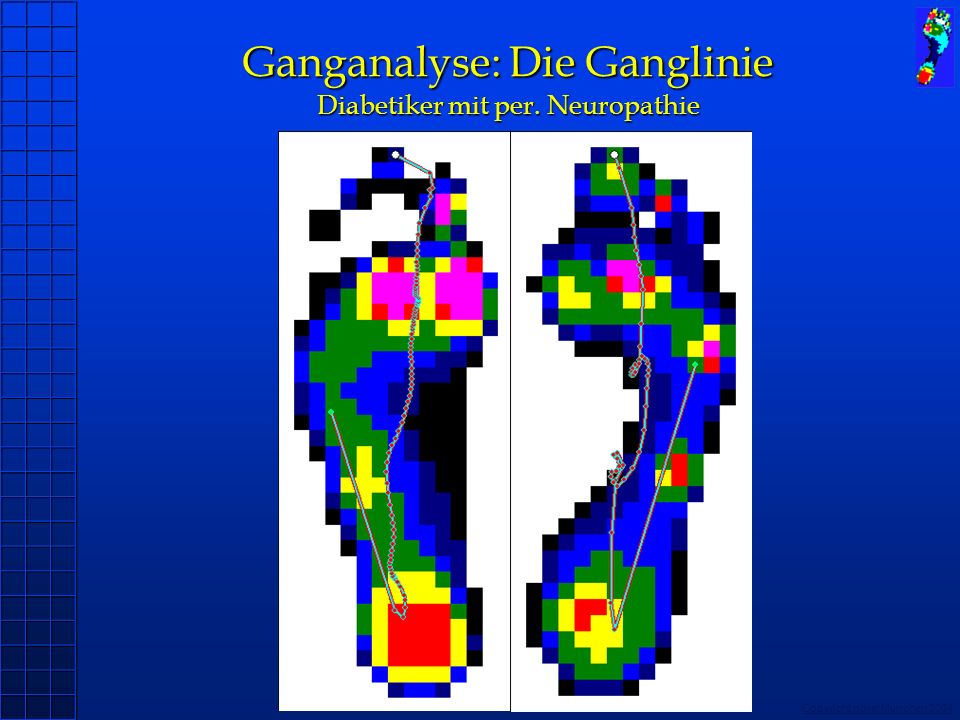 Ganganalyse: Die Ganglinie Diabetiker mit per. Neuropathie