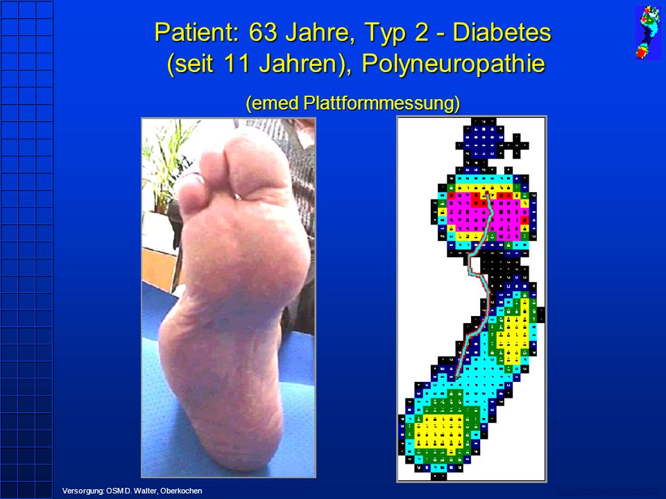 Patient: 63 Jahre, Typ 2 - Diabetes (seit 11 Jahren), Polyneuropathie (emed Plattformmessung)