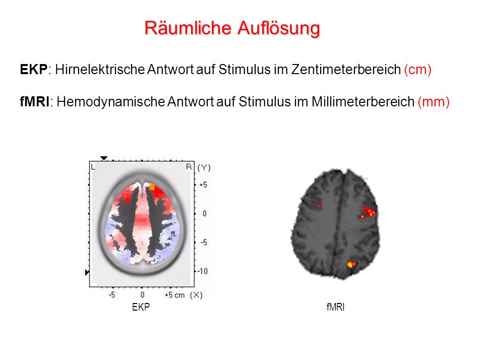 Räumliche Auflösung EKP: Hirnelektrische Antwort auf Stimulus im Zentimeterbereich (cm)