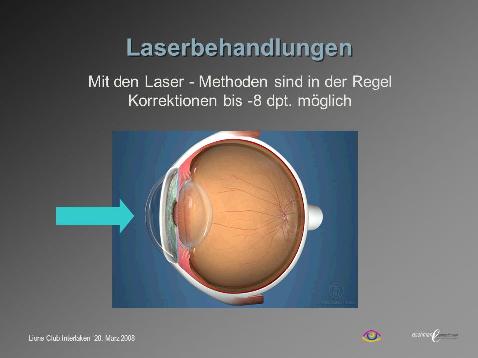 Laserbehandlungen Mit den Laser - Methoden sind in der Regel Korrektionen bis -8 dpt. möglich