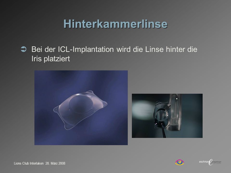 Hinterkammerlinse Bei der ICL-Implantation wird die Linse hinter die Iris platziert