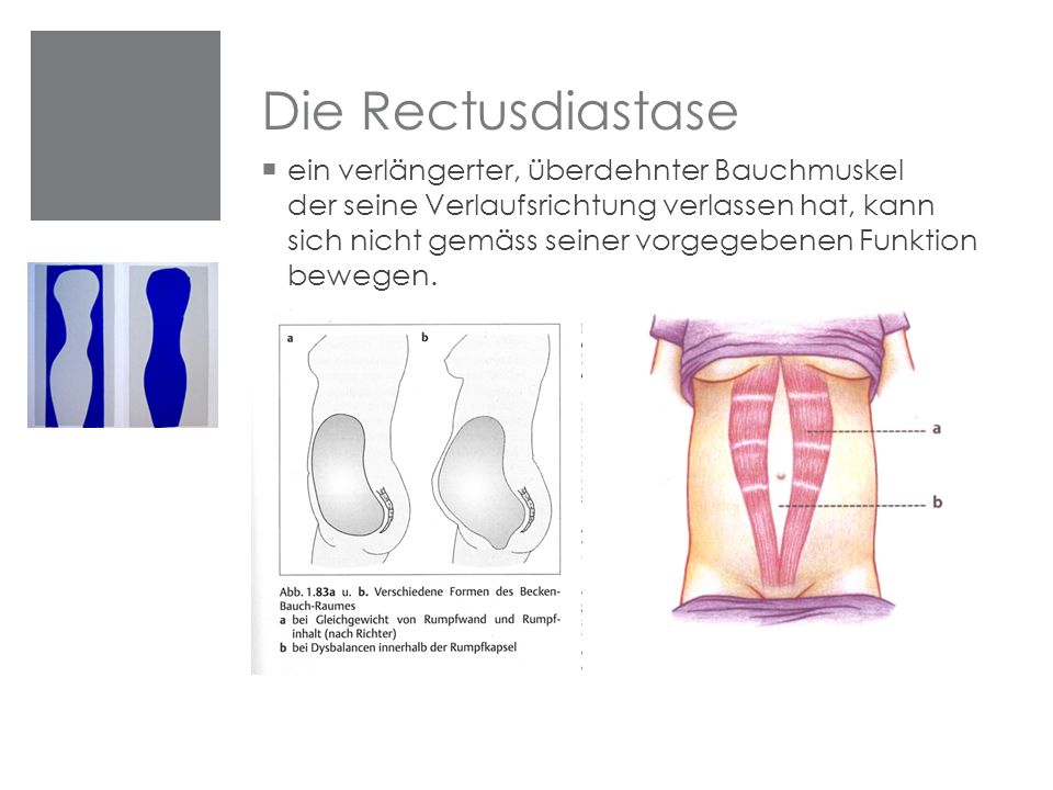 Die Rectusdiastase