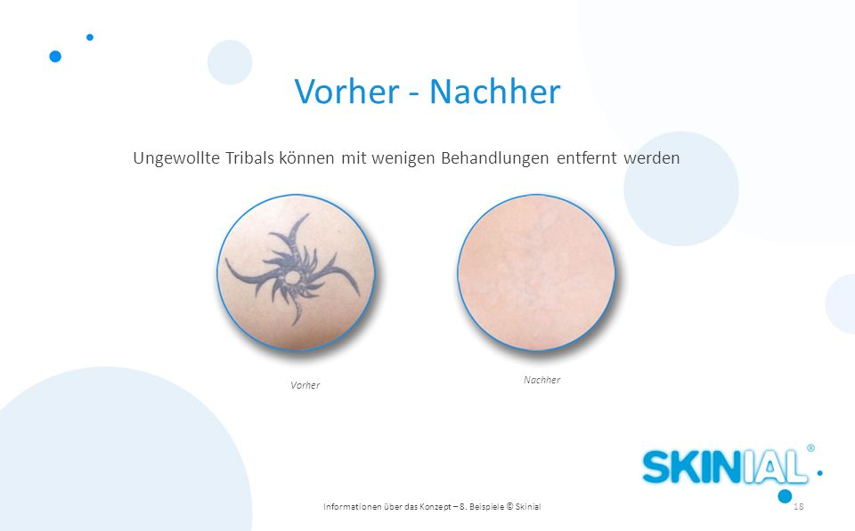 Vorher - Nachher Ungewollte Tribals können mit wenigen Behandlungen entfernt werden. Vorher. Nachher.