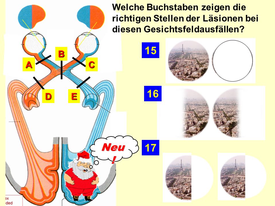 Welche Buchstaben zeigen die richtigen Stellen der Läsionen bei diesen Gesichtsfeldausfällen