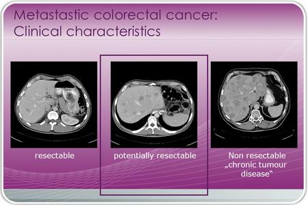 Resectablepotentially resectableNon resectable „chronic tumour disease“ Metastastic colorectal cancer: Clinical characteristics.