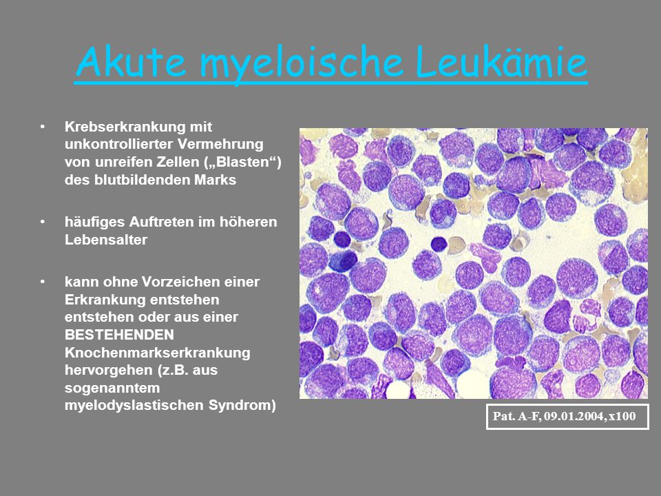 Akute myeloische Leukämie - ppt herunterladen