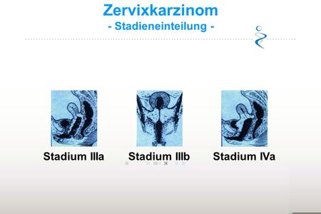 Zervixkarzinom - Stadieneinteilung - Stadium IIIa Stadium IIIb