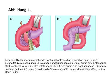 Abbildung 1. a.) b.) Legende: Die Duodenum-erhaltende Pankreaskopfresektion (Operation nach Beger) beinhaltet die Ausschälung des Bauchspeicheldrüsenkopfes,