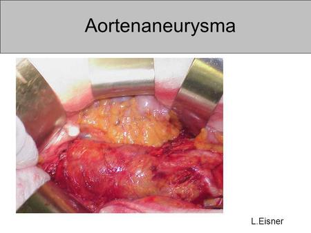 Aortenaneurysma L.Eisner.