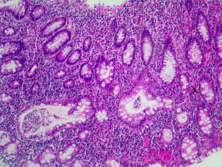 Colitis Ulcerosa: Basale Plasmozytose