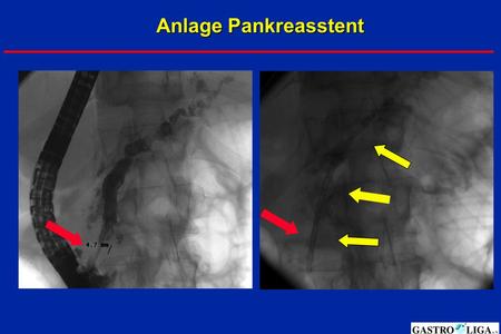 Anlage Pankreasstent.