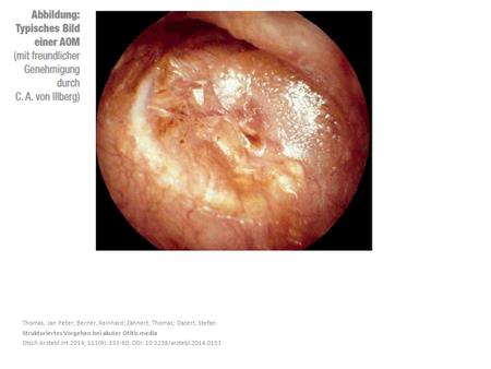 Thomas, Jan Peter; Berner, Reinhard; Zahnert, Thomas; Dazert, Stefan Strukturiertes Vorgehen bei akuter Otitis media Dtsch Arztebl Int 2014; 111(9): 151-60;