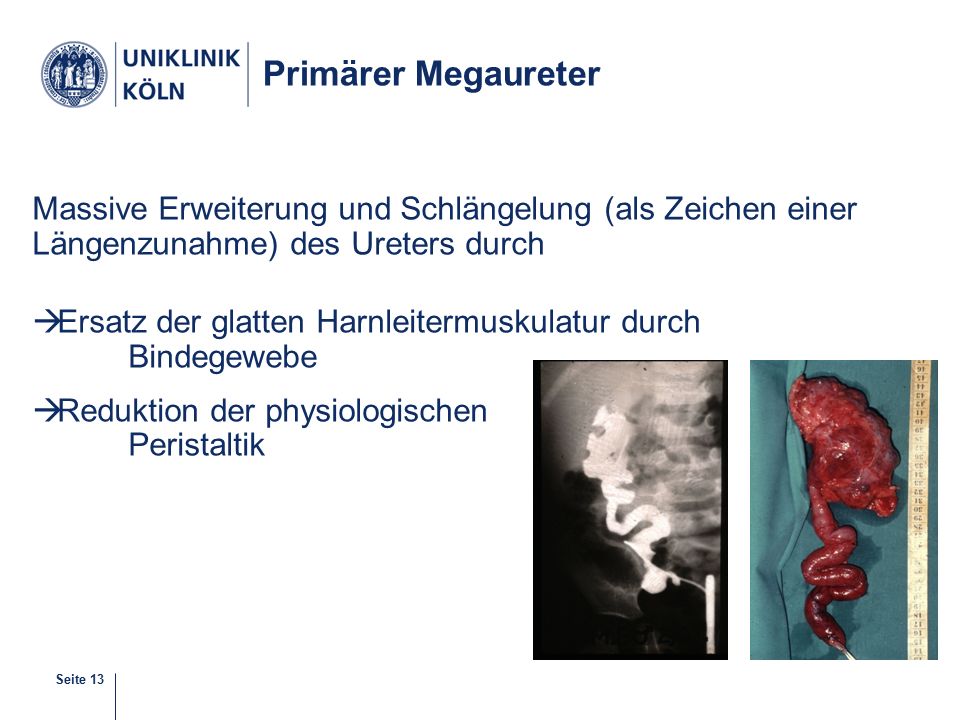 Primärer Megaureter Massive Erweiterung und Schlängelung (als Zeichen einer Längenzunahme) des Ureters durch.