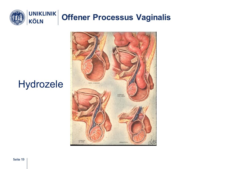 Offener Processus Vaginalis