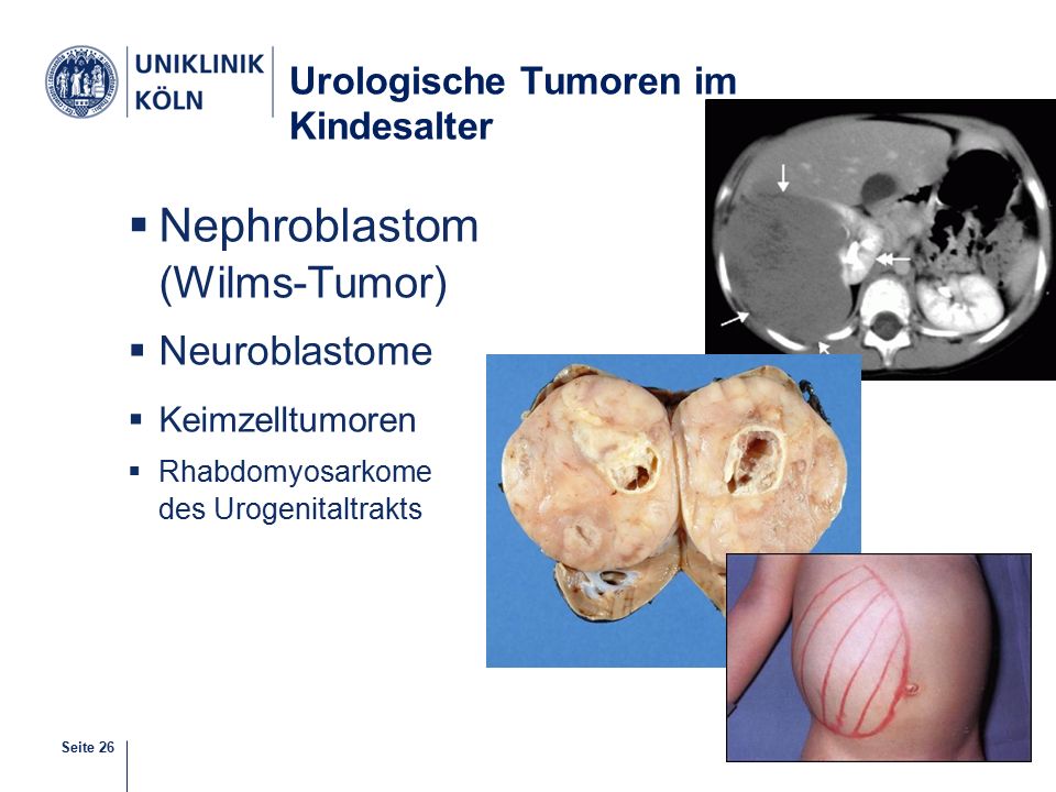 Urologische Tumoren im Kindesalter