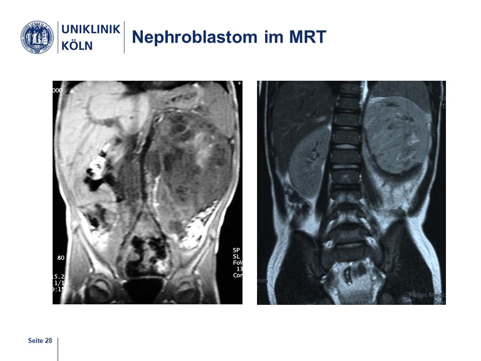 Nephroblastom im MRT