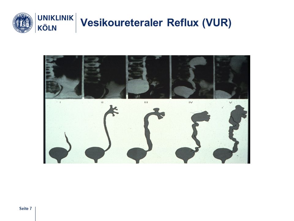 Vesikoureteraler Reflux (VUR)