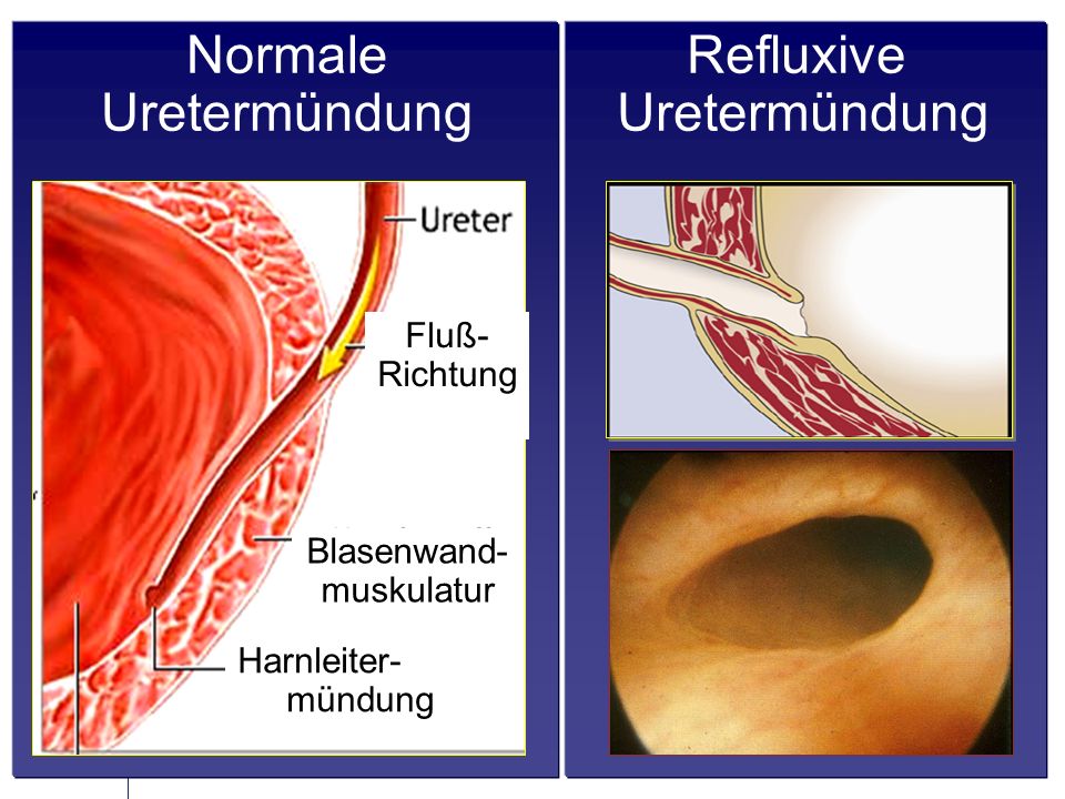 Normale Uretermündung Refluxive Uretermündung Fluß- Richtung