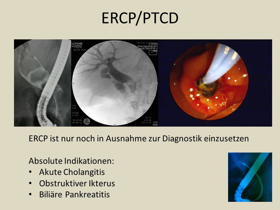 ERCP/PTCD ERCP ist nur noch in Ausnahme zur Diagnostik einzusetzen