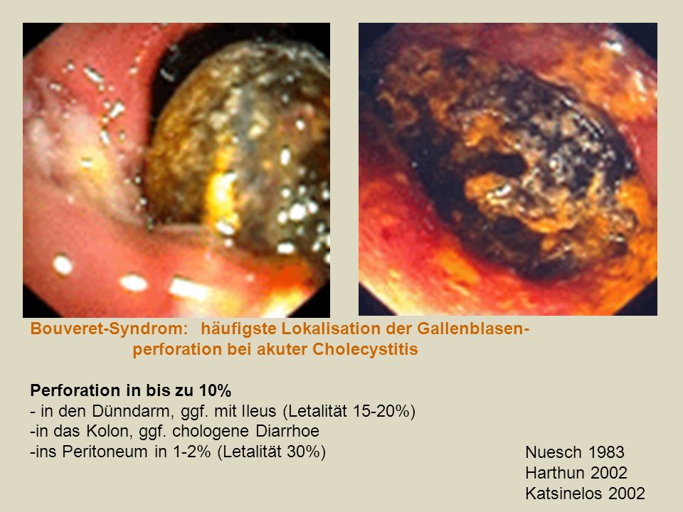 Bouveret-Syndrom: häufigste Lokalisation der Gallenblasen-