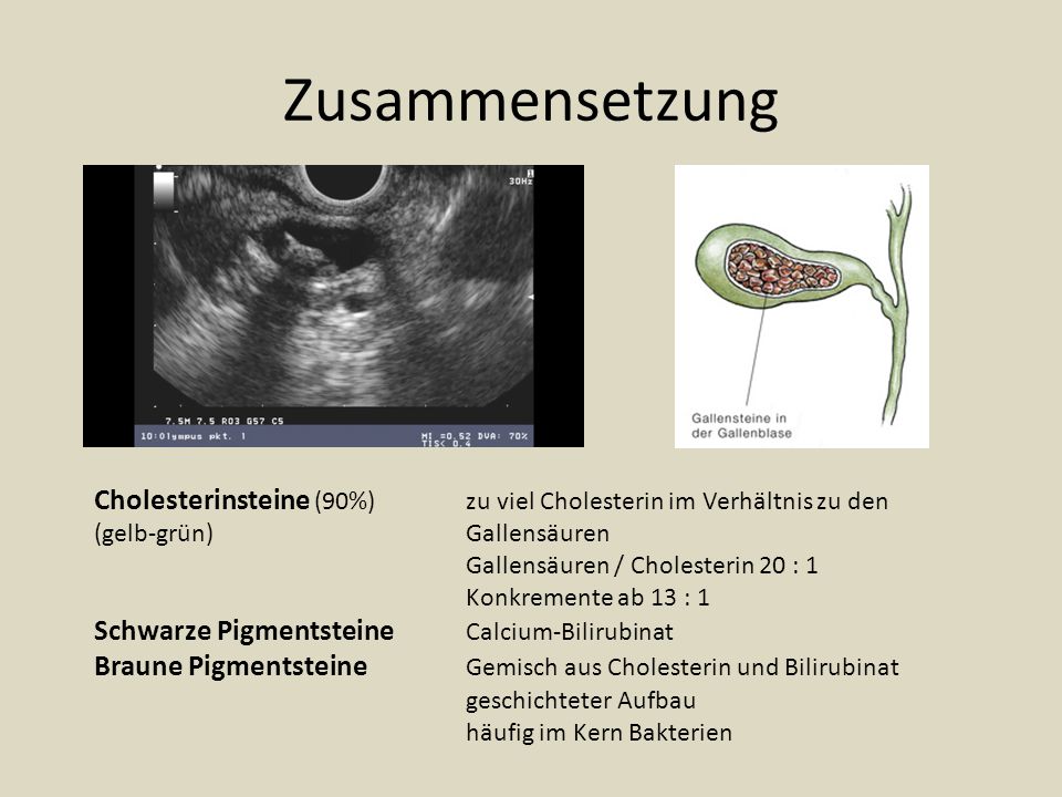 Zusammensetzung Cholesterinsteine (90%) zu viel Cholesterin im Verhältnis zu den. (gelb-grün) Gallensäuren.