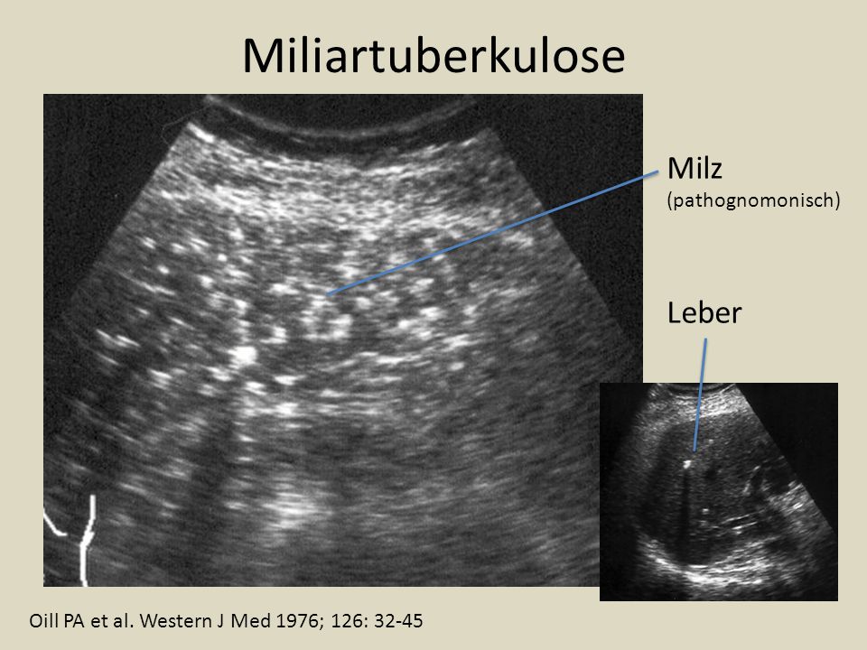 Miliartuberkulose Milz Leber (pathognomonisch)