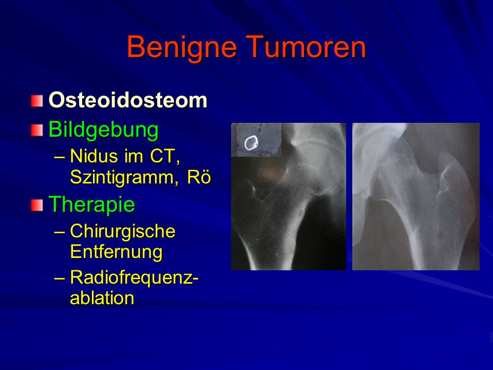 Benigne Tumoren Osteoidosteom Bildgebung Therapie