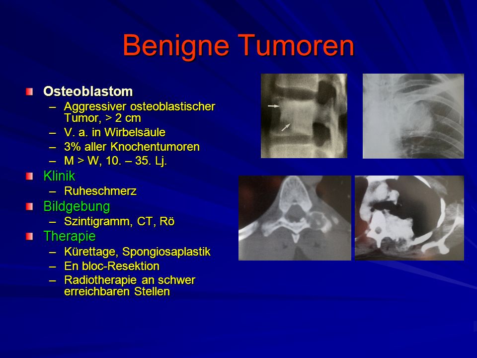 Benigne Tumoren Osteoblastom Klinik Bildgebung Therapie