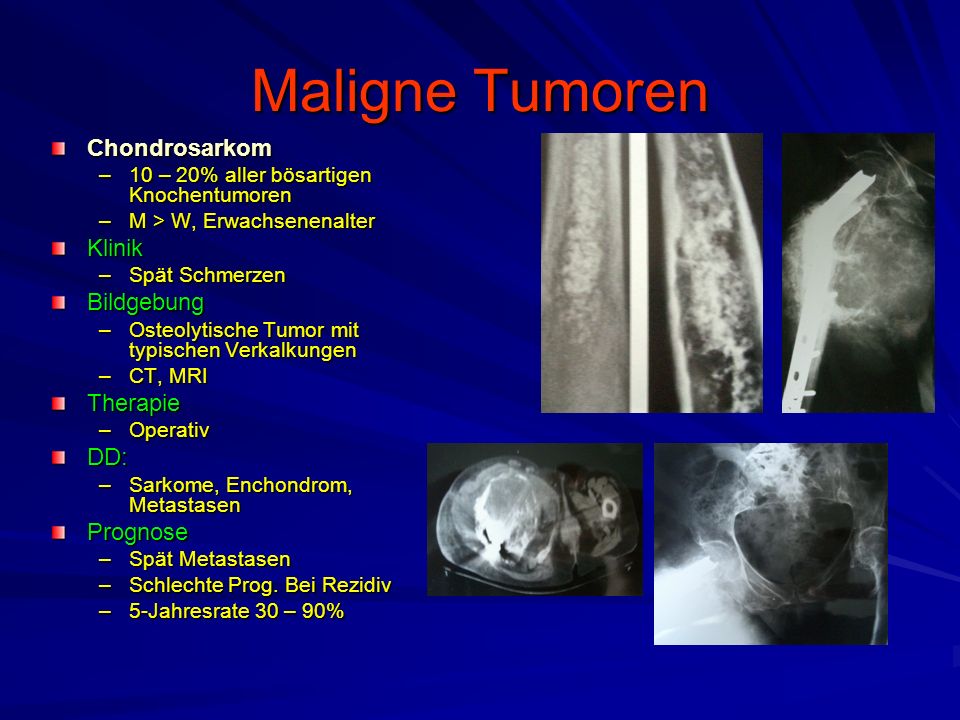 Maligne Tumoren Chondrosarkom Klinik Bildgebung Therapie DD: Prognose