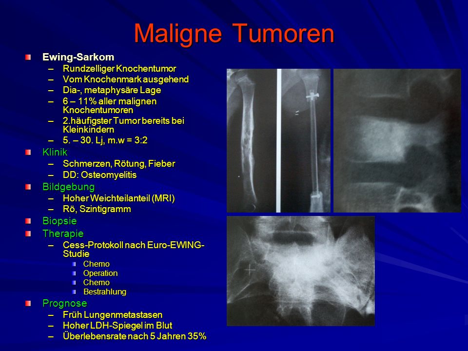 Maligne Tumoren Ewing-Sarkom Klinik Bildgebung Biopsie Therapie