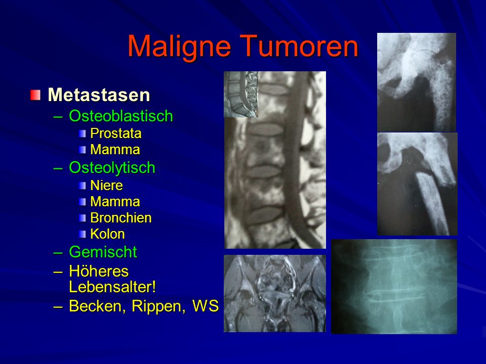 Maligne Tumoren Metastasen Osteoblastisch Osteolytisch Gemischt