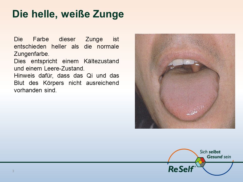 Die helle, weiße Zunge Die Farbe dieser Zunge ist entschieden heller als die normale Zungenfarbe.