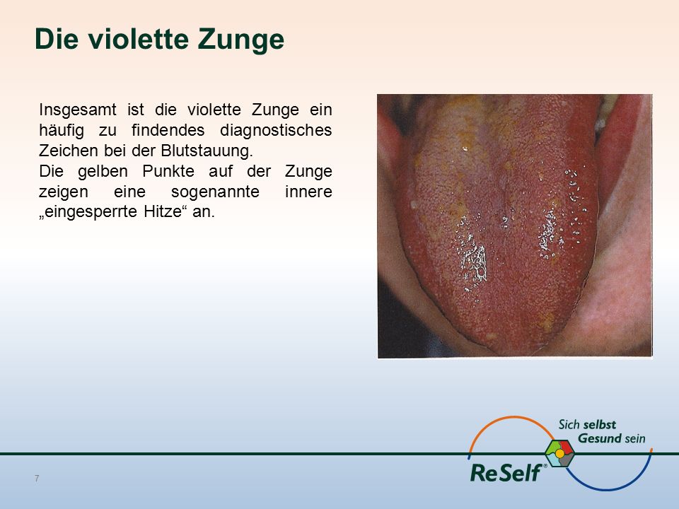 Die violette Zunge Insgesamt ist die violette Zunge ein häufig zu findendes diagnostisches Zeichen bei der Blutstauung.