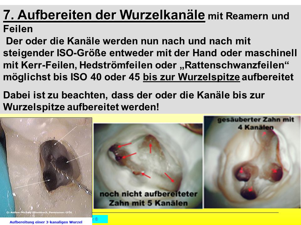 7. Aufbereiten der Wurzelkanäle mit Reamern und Feilen Der oder die Kanäle werden nun nach und nach mit steigender ISO-Größe entweder mit der Hand oder maschinell mit Kerr-Feilen, Hedströmfeilen oder „Rattenschwanzfeilen möglichst bis ISO 40 oder 45 bis zur Wurzelspitze aufbereitet