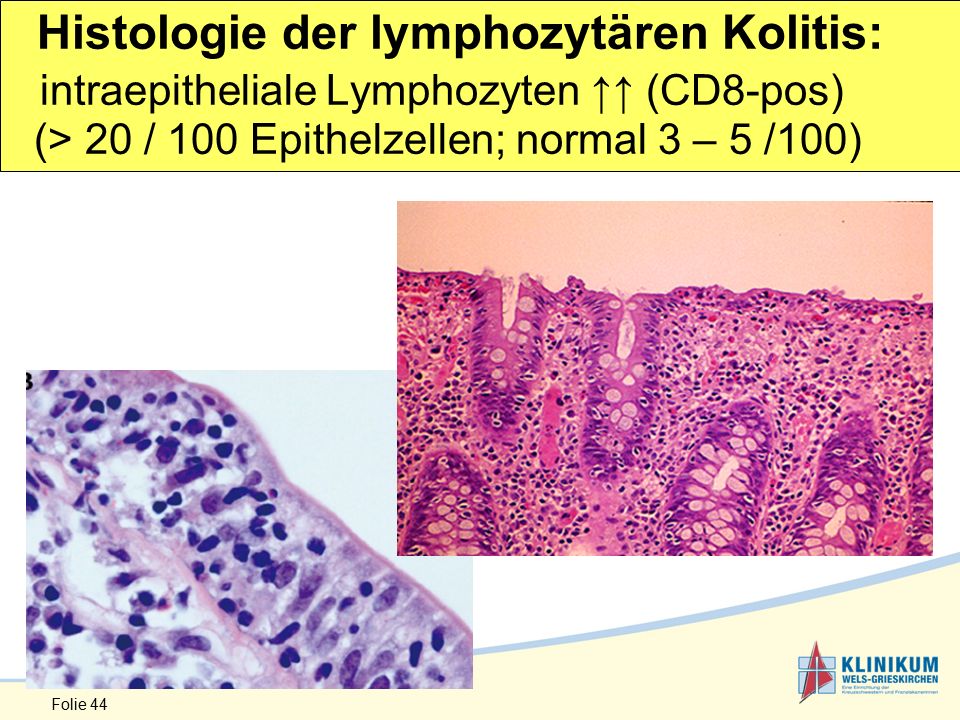 Histologie der lymphozytären Kolitis: intraepitheliale Lymphozyten ↑↑ (CD8-pos) (> 20 / 100 Epithelzellen; normal 3 – 5 /100)